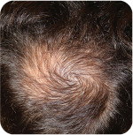 Before Treatment