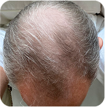 Before Treatment