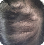 Before Treatment